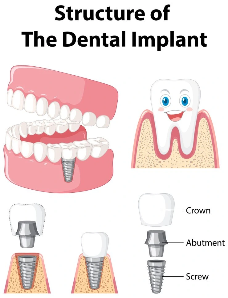 Dental Implant